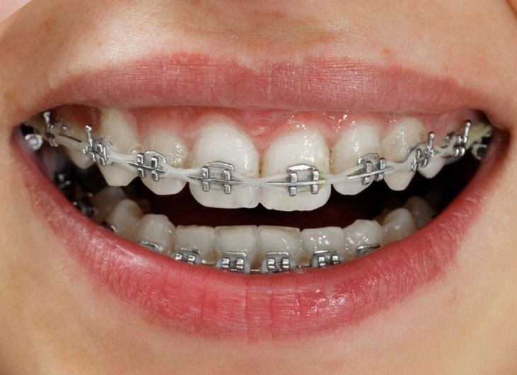 Niềng răng mắc cài kim loại có hiệu quả không? nuốt mắc cài niềng răng
