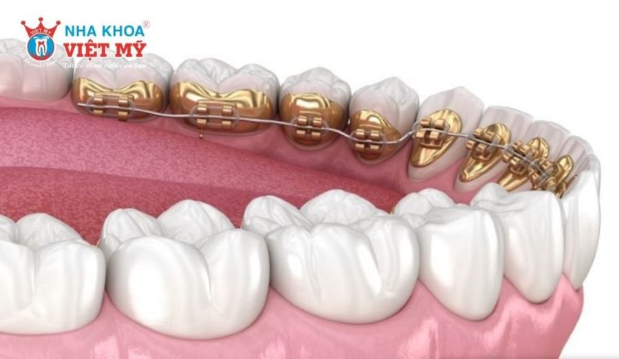 Niềng răng mắc cài kim loại mặt trong có mức giá từ 80 đến 115 triệu VND