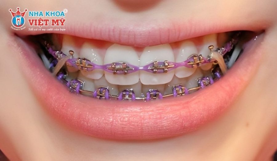 Niềng răng mắc cài kim loại truyền thống