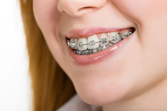 Niềng răng mắc cài kim loại là gì? Răng quặp vào trong