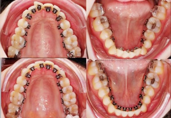 Niềng răng mắc cài mặt trong – niềng răng mặt trong giá bao nhiêu tiền?