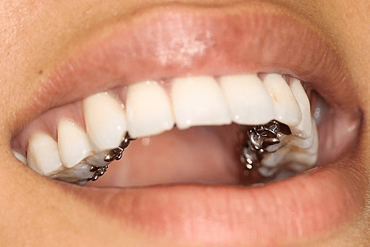 niềng răng mặt trong giá bao nhiêu tiền?: Giải pháp chỉnh nha đẹp không tì vết - Nha khoa JW