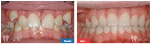 Top 4 ưu điểm của niềng răng mắc cài sứ thẩm mỹ hiệu quả nhanh nhất 4