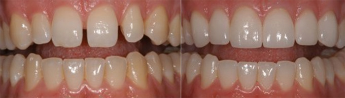 Trước và sau khi niềng răng có kết quả như thế nào? 13
