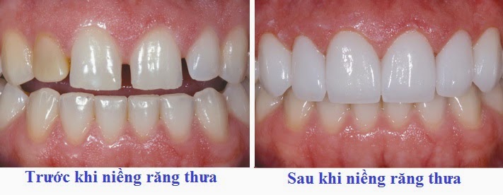 20 Hình ảnh sâu răng tại các vị trí và giai đoạn sâu răng