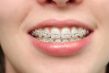 niềng răng giảm tuổi thọ có đúng không?