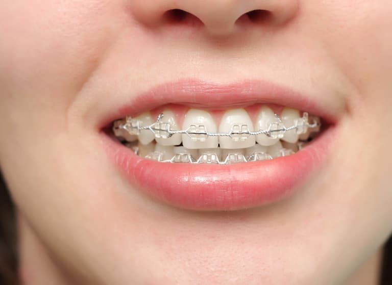 Niềng răng đẹp cỡ nào Hình ảnh lột xác trước và sau khi niềng  Nha khoa  Quốc Tế KAIYEN