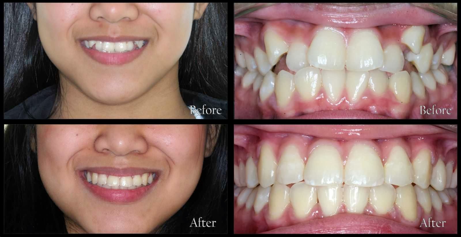 Trước và sau khi niềng răng có kết quả như thế nào? 9