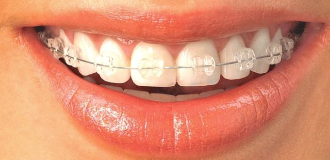 Ai cần niềng răng? Độ tuổi thích hợp để niềng răng? Niềng răng sau sinh có được không