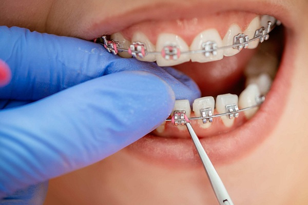 nuốt mắc cài niềng răng