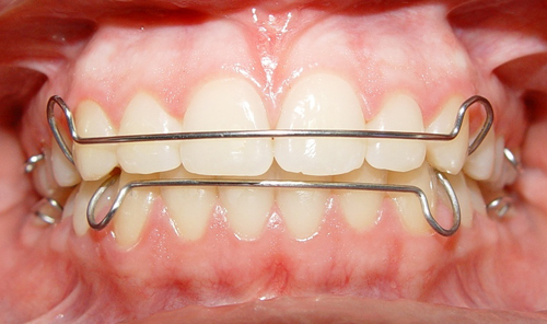 Phải mang khí cụ duy trì sau niềng răng trong bao lâu? cách làm răng bớt hô