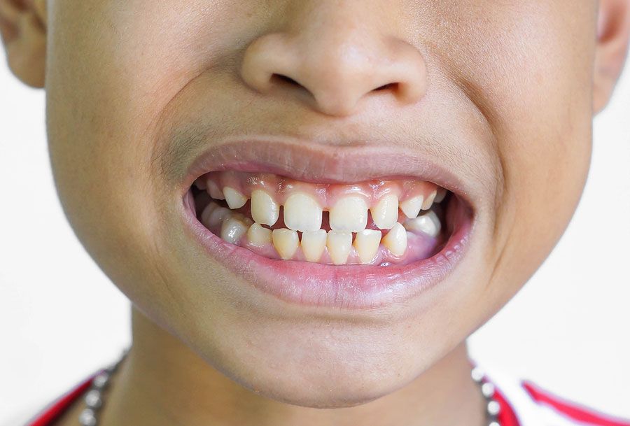 Răng Thưa Ở Trẻ Em Phải Làm Sao? Có Khắc Phục Được Không? Bé mọc răng vĩnh viễn bị thưa cần điều trị thế nào?