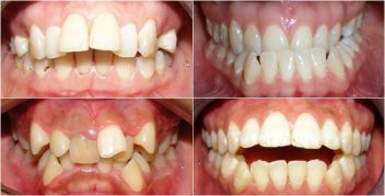 Niềng 2 răng cửa bị lệch bao lâu thì hiệu quả?