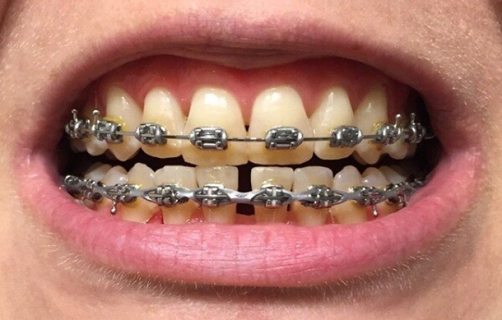 Mách bạn cách khắc phục răng bị ố vàng khi niềng nhanh và hiệu quả - Niềng răng không thành công