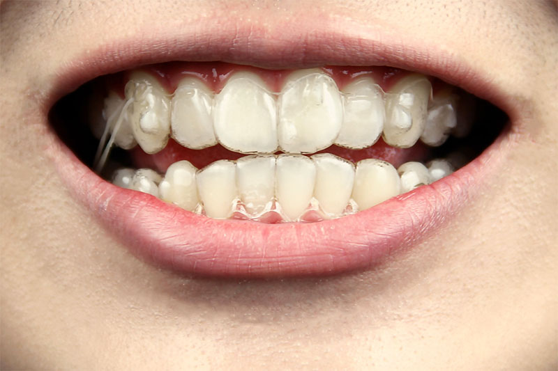 Răng cửa hình chữ V là gì? Giải pháp nào để có răng cửa đẹp?