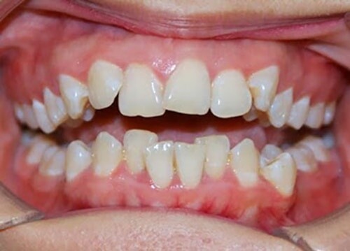 răng cửa bị nghiêng