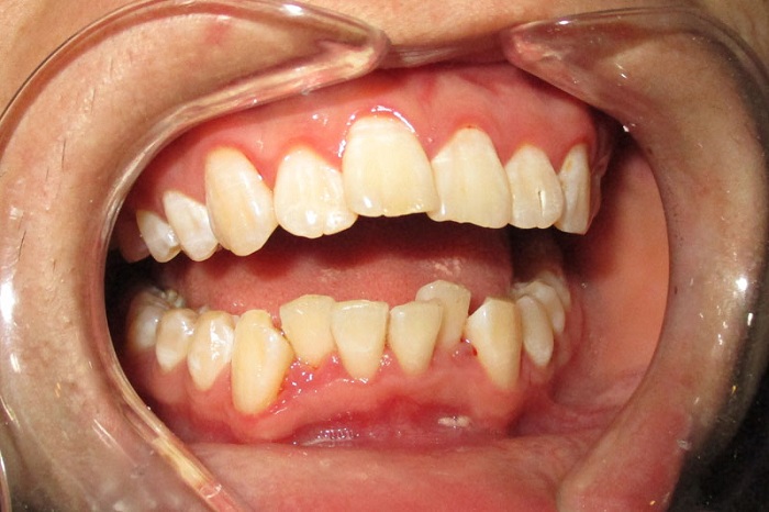 răng cửa bị nghiêng - Phương pháp khắc phục HIỆU QUẢ