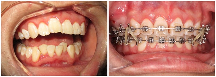 Niềng 2 răng cửa bị lệch bao lâu thì hiệu quả? - Phương pháp khắc phục HIỆU QUẢ