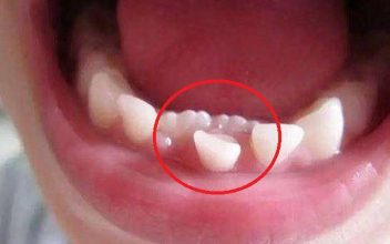 Răng sữa chưa rụng răng vĩnh viễn đã mọc