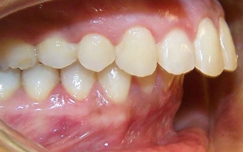 Răng Hô Nặng: Nguyên Nhân, Tác Hại Và Cách Điều Trị Hiệu Quả - Nguyên nhân răng hô là gì