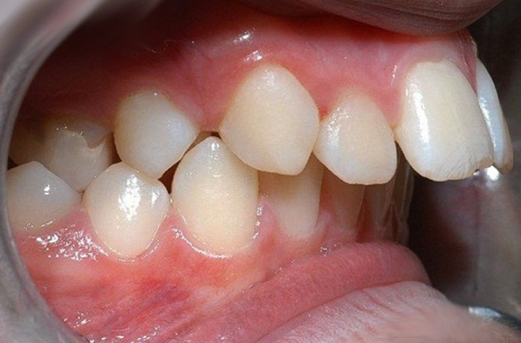  Răng hô là tình trạng chệch khớp cắn 