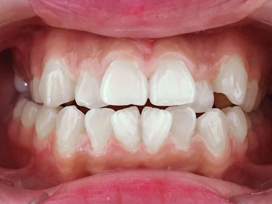 Thế nào là răng khấp khểnh? Nguyên nhân và cách khắc phục - răng 9630 là gì