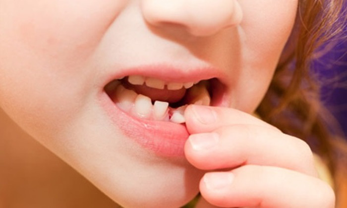 Những nguyên nhân khiến răng mọc lệch ở trẻ