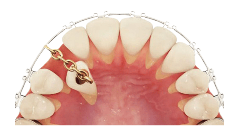 giá niềng răng nanh mọc ngầm