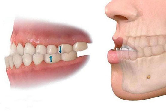 Răng quặp vào trong? tướng số người răng quặp vào trong và các cách điều trị