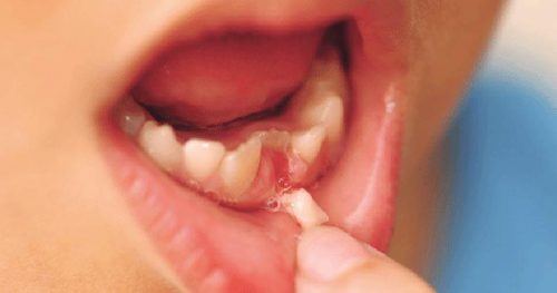 Răng sữa chưa rụng răng vĩnh viễn đã mọc thì phải làm sao? Răng sữa chưa rụng răng vĩnh viễn đã mọc