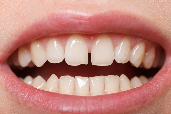 Răng thưa nên niềng răng hay bọc răng sứ - răng thưa nên niềng hay bọc sứ