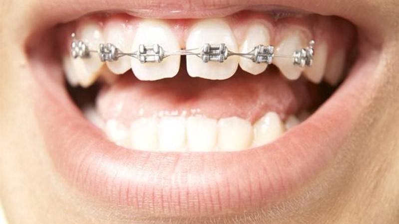 Răng thưa nên niềng hay bọc sứ mới là giải pháp tốt nhất? - răng thưa nên niềng hay bọc sứ