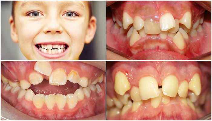 Răng trẻ mọc lệch phải làm sao? Sửa thế nào cho đều đẹp?
