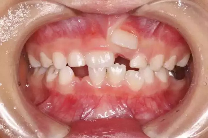 Giải mã trường hợp răng sữa chưa rụng răng vĩnh viễn đã mọc ở trẻ - Răng sữa chưa rụng răng vĩnh viễn đã mọc