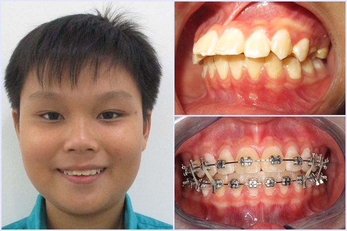 Nguyên nhân răng hô là gì - Dấu Hiệu Nhận Biết Và Cách Điều Trị Hiệu Quả
