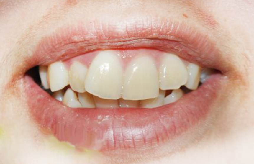 răng cửa bị nghiêng Nha Khoa Quốc Tế Á Châu