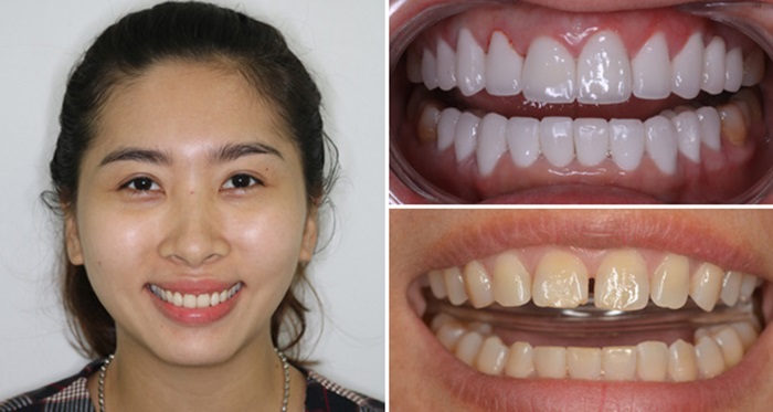 răng thưa nên niềng hay bọc sứ