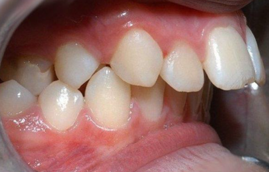 Tác hại của hàm răng vẩu - răng hô có xấu không