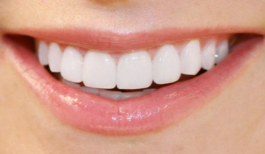 Tiêu chuẩn của hàm răng đẹp tự nhiên 