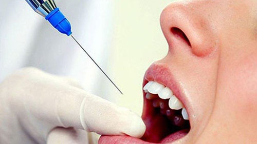 Tìm hiểu những kỹ thuật gây tê khi nhổ răng - Cắm minivis bị viêm