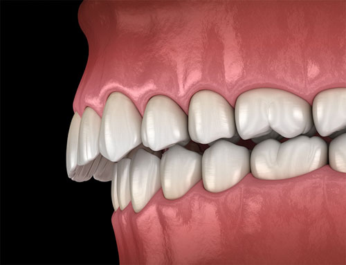 Cách nhận biết RĂNG HÔ do răng hay do hàm - cách nhận biết hô hàm hay hô răng
