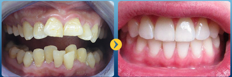 Răng bị vẩu – Nguyên nhân và cách khắc phục hiệu quả - Nguyên nhân răng hô là gì