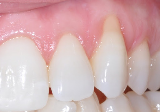 Niềng răng bị tụt lợi - nguyên nhân và cách xử lý