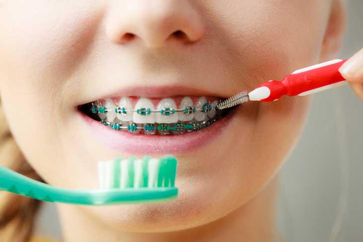 Bí quyết vệ sinh răng miệng khi nắn chỉnh răng ⋆ niềng răng cho trẻ em giá bao nhiêu bao nhiêu