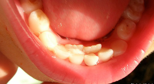 Xử lý tình huống răng vĩnh viễn mọc nhưng răng sữa chưa rụng. Răng sữa chưa rụng răng vĩnh viễn đã mọc